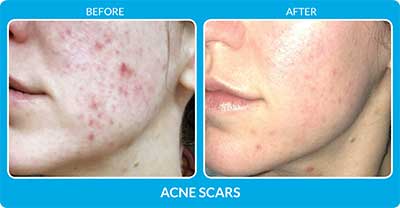 Acne Scars Before and After Photos at Petra’s Massage Therapy & Weight Loss Clinic in Oklahoma City