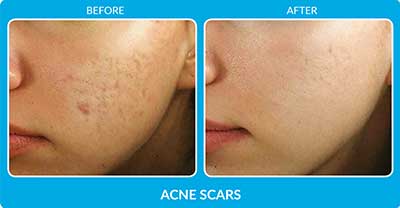 Acne Scars Before and After Photos at Petra’s Massage Therapy & Weight Loss Clinic in Oklahoma City