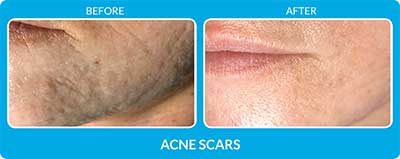 Acne Scars Before and After Photos at Petra’s Massage Therapy & Weight Loss Clinic in Oklahoma City