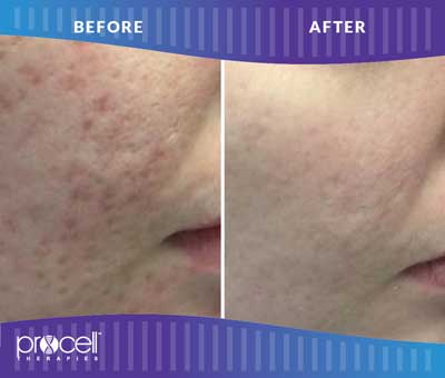 Acne Scars Before and After Photos at Petra’s Massage Therapy & Weight Loss Clinic in Oklahoma City