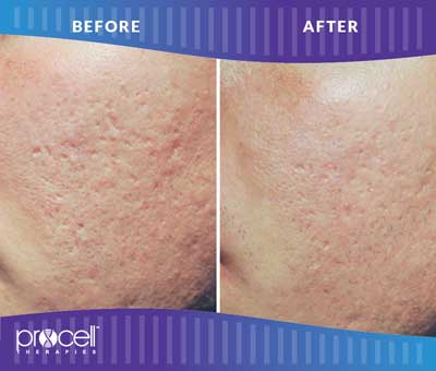 Acne Scars Before and After Photos at Petra’s Massage Therapy & Weight Loss Clinic in Oklahoma City