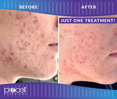 Acne Scars Before and After Photos at Petra’s Massage Therapy & Weight Loss Clinic in Oklahoma City