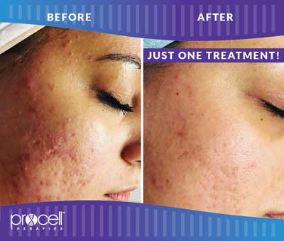 Acne Scars Before and After Photos at Petra’s Massage Therapy & Weight Loss Clinic in Oklahoma City