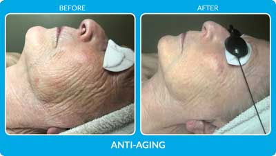 Anti Aging Before and After Photos at Petra’s Massage Therapy & Weight Loss Clinic in Oklahoma City