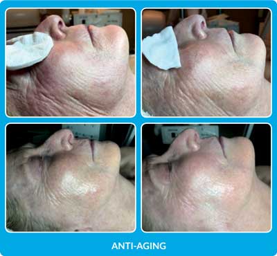 Anti Aging Before and After Photos at Petra’s Massage Therapy & Weight Loss Clinic in Oklahoma City