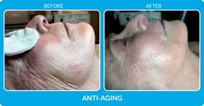 Anti Aging Before and After Photos at Petra’s Massage Therapy & Weight Loss Clinic in Oklahoma City