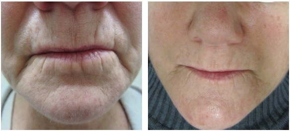 ProCell Microchanneling Treatment Before and After Pictures in Oklahoma City, OK