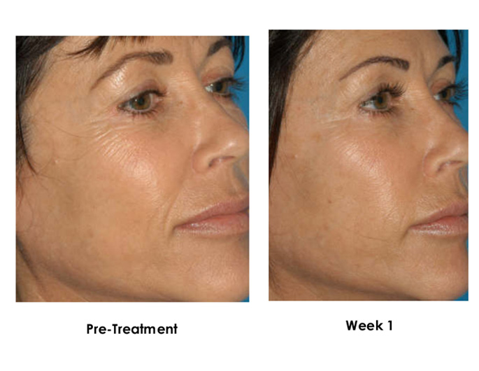 ProCell Microchanneling Treatment Before and After Pictures in Oklahoma City, OKC