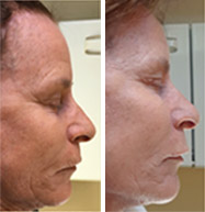 ProCell Microchanneling Treatment Before and After Pictures in Oklahoma City, OKC