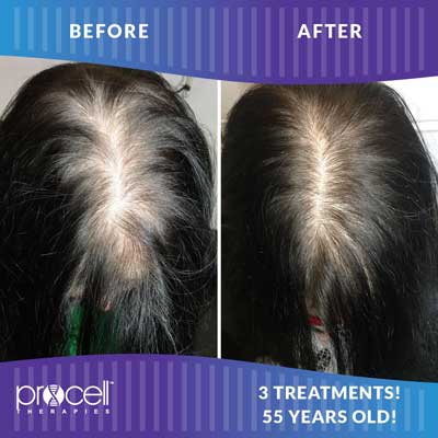 Procell Hair Regrowth Before and After Photos at Petra’s Massage Therapy & Weight Loss Clinic in Oklahoma City