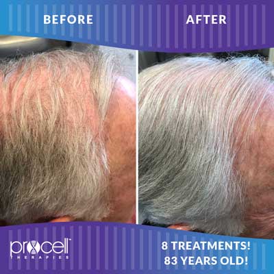 Procell Hair Regrowth Before and After Photos at Petra’s Massage Therapy & Weight Loss Clinic in Oklahoma City