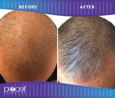 Procell Hair Regrowth Before and After Photos at Petra’s Massage Therapy & Weight Loss Clinic in Oklahoma City