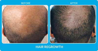 Procell Hair Regrowth Before and After Photos at Petra’s Massage Therapy & Weight Loss Clinic in Oklahoma City