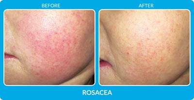 Rosacea Before and After Photos at Petra’s Massage Therapy & Weight Loss Clinic in Oklahoma City