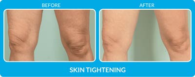 Skin Tightening Before and After Photos at Petra’s Massage Therapy & Weight Loss Clinic in Oklahoma City