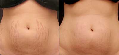 Stretch Marks Before and After Photos at Petra’s Massage Therapy & Weight Loss Clinic in Oklahoma City