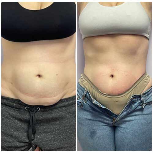 Body Sculpting Before and After in Oklahoma City OKC 