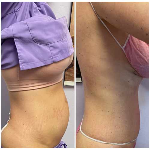 Body Sculpting Before and After in Oklahoma City OKC 