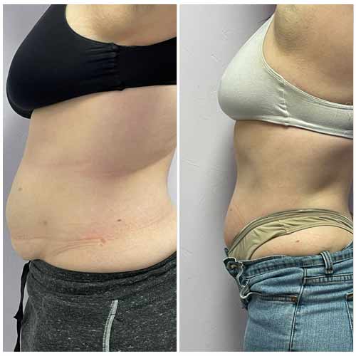 Body Sculpting Before and After in Oklahoma City OKC 