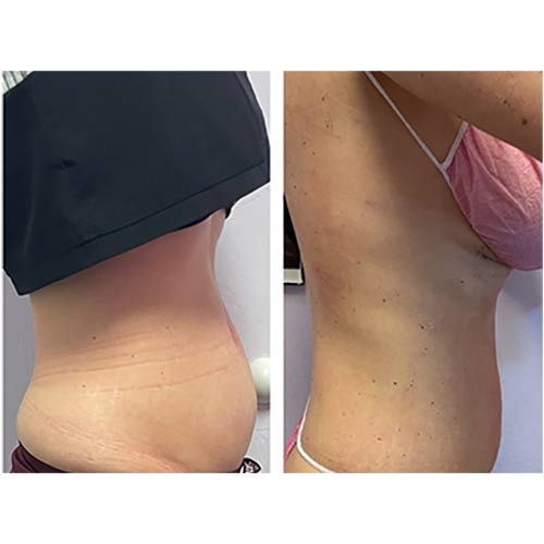 High Intensity Focused Ultrasound (HIFU) Treatment Specialist Near Me in Oklahoma City OKC High Intensity Focused Ultrasound (HIFU) Treatment Specialist Near Me in Oklahoma City OKC