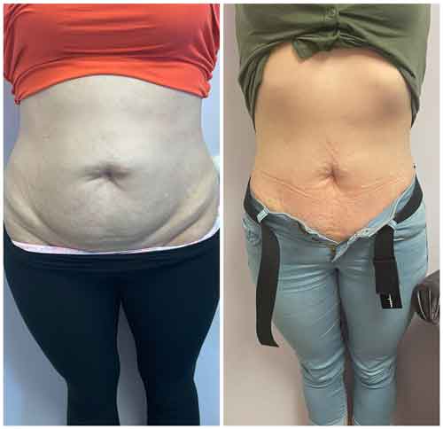 High Intensity Focused Ultrasound (HIFU) Treatment Specialist Near Me in Oklahoma City OKC High Intensity Focused Ultrasound (HIFU) Treatment Specialist Near Me in Oklahoma City OKC