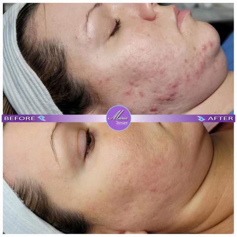 ProCell Microchanneling Treatment Before and After Pictures in Oklahoma City, OK