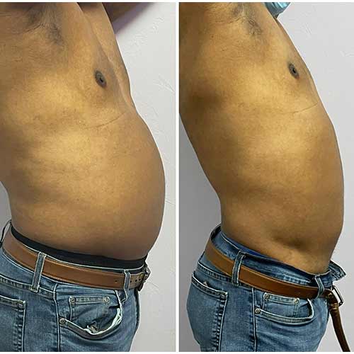 Body Sculpting Before and After in Oklahoma City OKC 