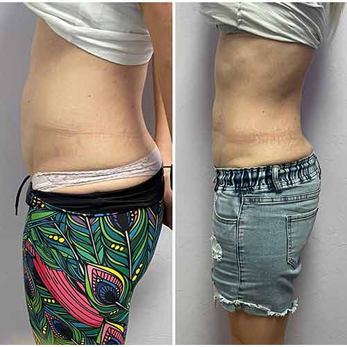 Body Sculpting Before and After in Oklahoma City OKC 