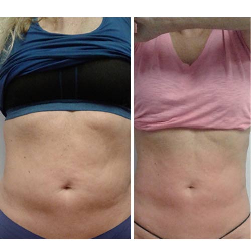 Body Sculpting Before and After in Oklahoma City OKC 