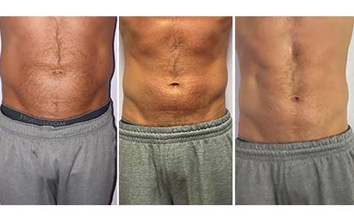 Body Sculpting Before and After in Oklahoma City OKC 