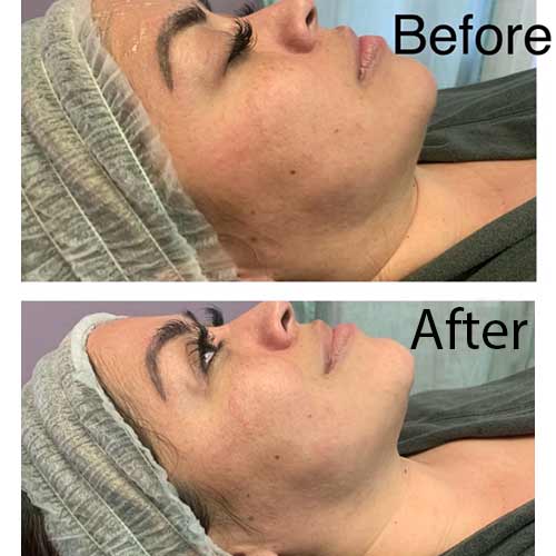 ProCell Microchanneling Treatment Before and After Pictures in Oklahoma City, OK