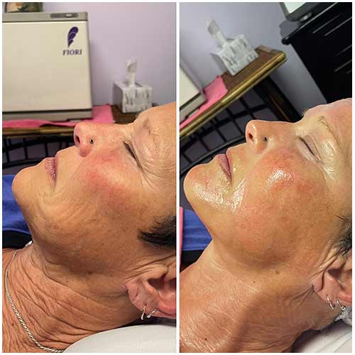 ProCell Microchanneling Treatment Before and After Pictures in Oklahoma City, OK