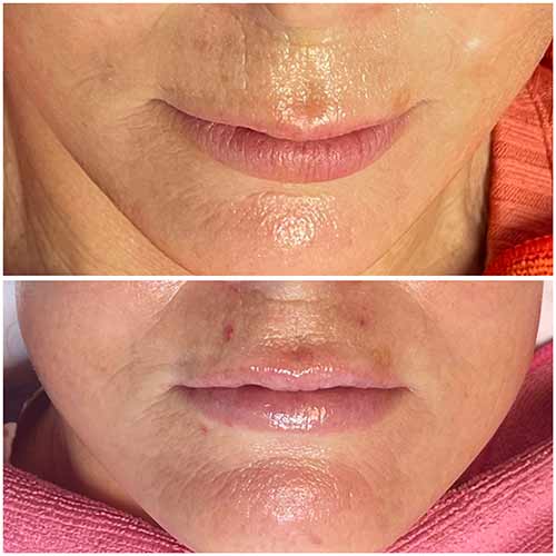 Non-Invasive Lip Filler Specialist Near Me in Oklahoma City OKC