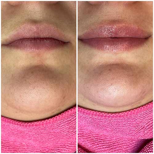 Non-Invasive Lip Filler Specialist Near Me in Oklahoma City OKC