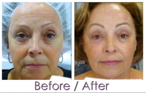 ProCell Microchanneling Treatment Before and After Pictures in Oklahoma City, OK