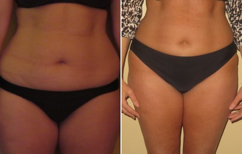 Vevazz Laser Light Lipo Therapy Before and After