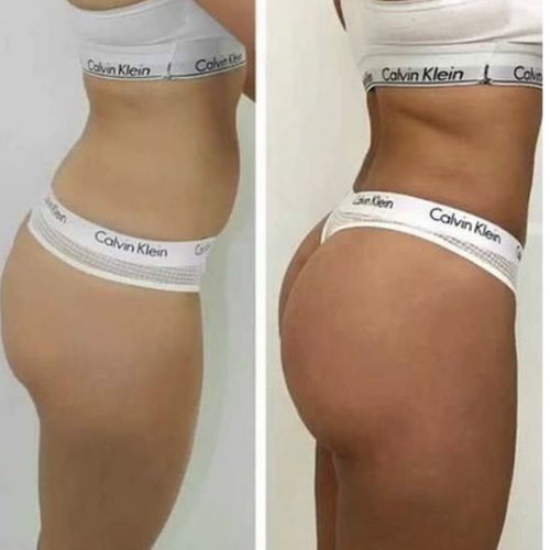 Booty Lift Before and After in Oklahoma City OKC