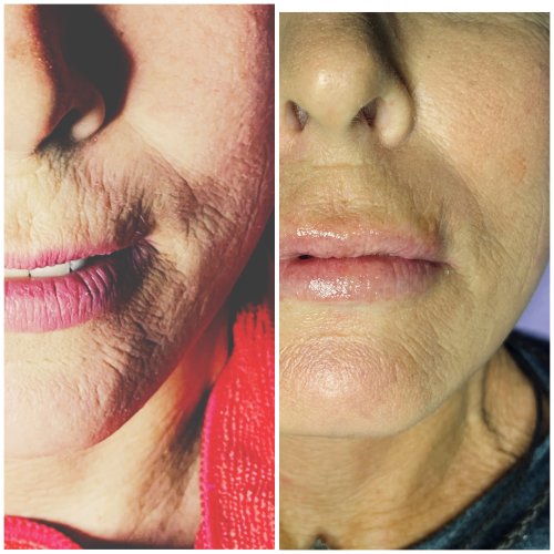 ProCell Microchanneling Treatment Before and After Pictures in Oklahoma City, OK