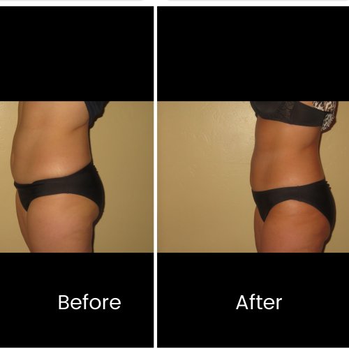 Body shape Specialist Near Me in Oklahoma City, OKC