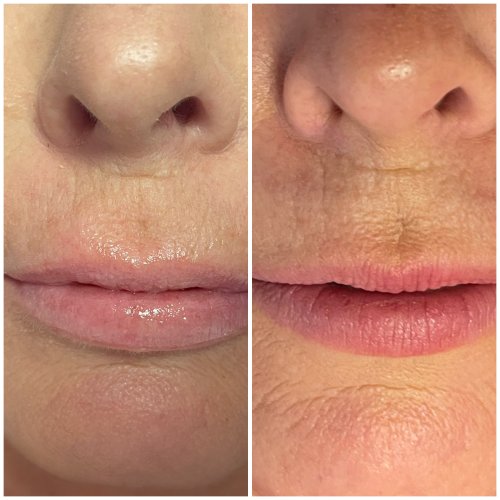 Non-Invasive Lip Filler Specialist Near Me in Oklahoma City OKC