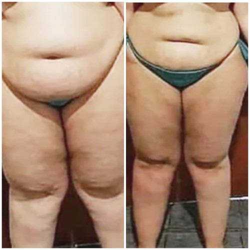 Fat Freezing Specialist Near Me in Oklahoma City, OKC