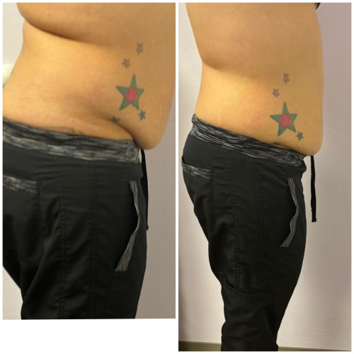 Fat Freezing Specialist Near Me in Oklahoma City, OKC