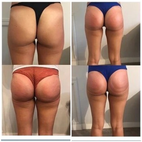 Booty Lift Before and After in Oklahoma City OKC