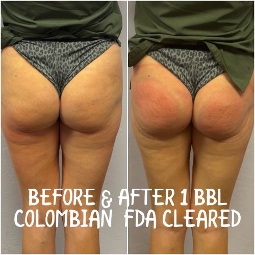 Booty Lift Before and After in Oklahoma City OKC