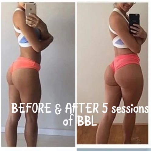 Booty Lift Before and After in Oklahoma City OKC