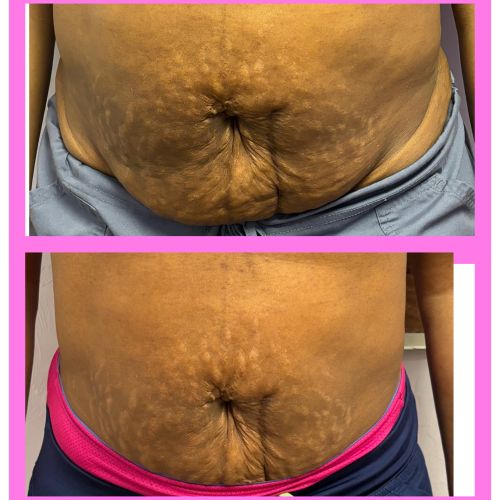 Body Sculpting Before and After in Oklahoma City OKC 