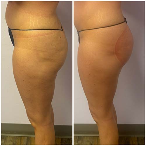 Booty Lift Before and After in Oklahoma City OKC Booty Lift Before and After in Oklahoma City OKC