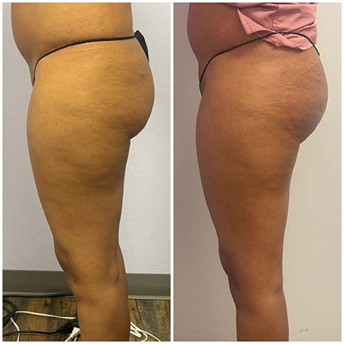 Booty Lift Before and After in Oklahoma City OKC Booty Lift Before and After in Oklahoma City OKC