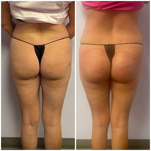 Booty Lift Before and After in Oklahoma City OKC Booty Lift Before and After in Oklahoma City OKC