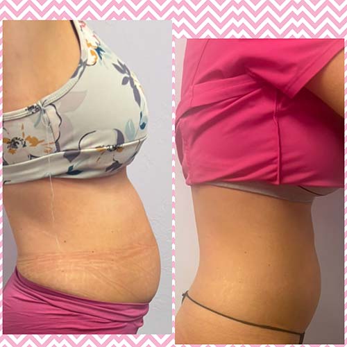 Body Sculpting Before and After in Oklahoma City OKC Body Sculpting Before and After in Oklahoma City OKC